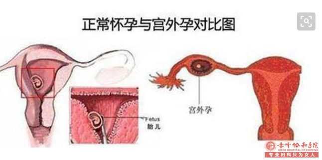 宁德宁城县患有宫外孕会有哪些症状提示？